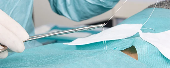 Besnijdenis, circumcisie | Dokter van Amsterdam